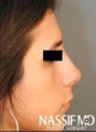 Female Primary Rhinoplasty