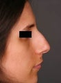 Female Primary Rhinoplasty
