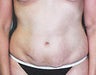 Female patient who underwent liposuction