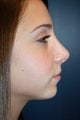Nose Surgery