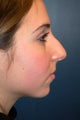 Nose Surgery