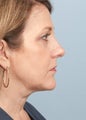 Neck Liposuction