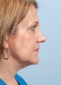 Neck Liposuction