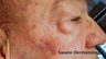 Mohs Surgery