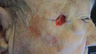 Mohs Surgery