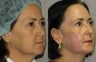 Laser Skin Resurfacing