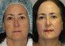 Laser Skin Resurfacing