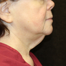 Neck Lift Surgery