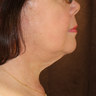 Neck Lift Surgery