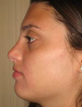 Nose Surgery
