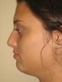 Nose Surgery