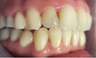Severe arch collapse treated with Invisalign