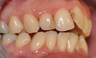 Severe arch collapse treated with Invisalign