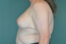 Breast Lift