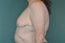 Breast Lift