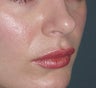 Lip Augmentation