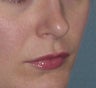 Lip Augmentation
