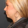 Chin Augmentation