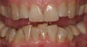 Veneers