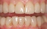 Veneers