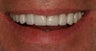 55 Year Old Male gets Smile Makeover