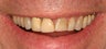 55 Year Old Male gets Smile Makeover