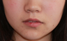 Fillers to Nasolabial Folds/Midface