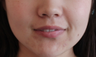Fillers to Nasolabial Folds/Midface