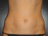 SmartLipo MPX