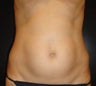 SmartLipo MPX