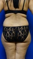Brazilian Butt Lift
