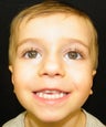 Otoplasty