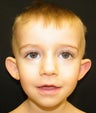 Otoplasty