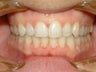 Cross bite of the front teeth