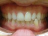 Cross bite of the front teeth