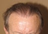 Neograft FUE hair transplant results