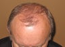 Neograft FUE hair transplant results
