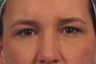 Juvederm Ultra for under-eye bags