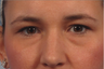 Juvederm Ultra for under-eye bags