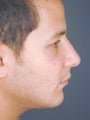 Male Chin Implant