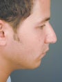 Male Chin Implant