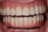 Same Day Teeth- Immediate implants and teeth