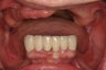 Same Day Teeth- Immediate implants and teeth