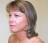 Band Aid "Mini" Facelift Results