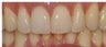 How to shorten a long tooth with Invisalign and without trimming it