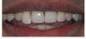 How to shorten a long tooth with Invisalign and without trimming it