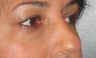 Restylane