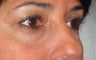 Restylane