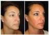 Ultherapy