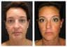 Ultherapy